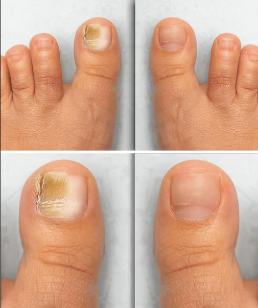 Feet Mantar - Funjen Kremi ile tedaviden önce ve sonra