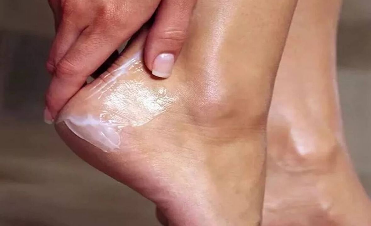 Fungent Krem ile Ayak Mangarı Nasıl Tedavi Edilir