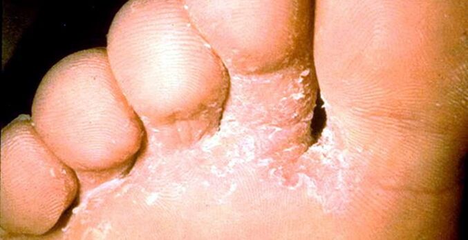 Ayak parmakları arasındaki cilt mantarının lezyonu