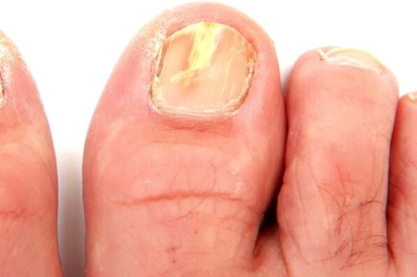 mantar enfeksiyonu nedeniyle tırnak plağına zarar gelmesi