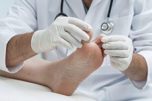 ayak mantarının doktor tarafından teşhisi